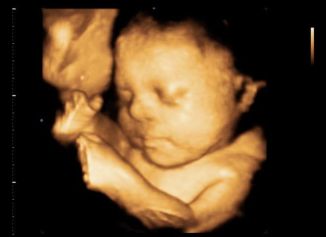 Ultrasound and Autism: Association, Link, or Coincidence?